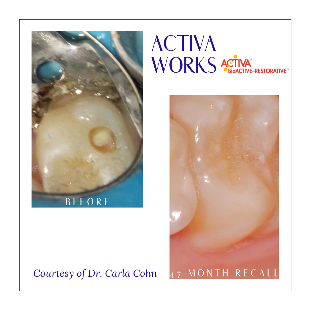 PulpdenTweets's tweet photo. For today's #ThrowbackThursday, we are featuring this great #ACTIVABioACTIVERESTORATIVE case! Courtesy of Dr. Carla Cohn.

If you would like to share your clinical images of Pulpdent products, please email leahberk@pulpdent.com  

#TBT #ACTIVAWORKS #ACTIVA #ACTIVABioACTIVE https://t.co/OuLyJtZe6x
