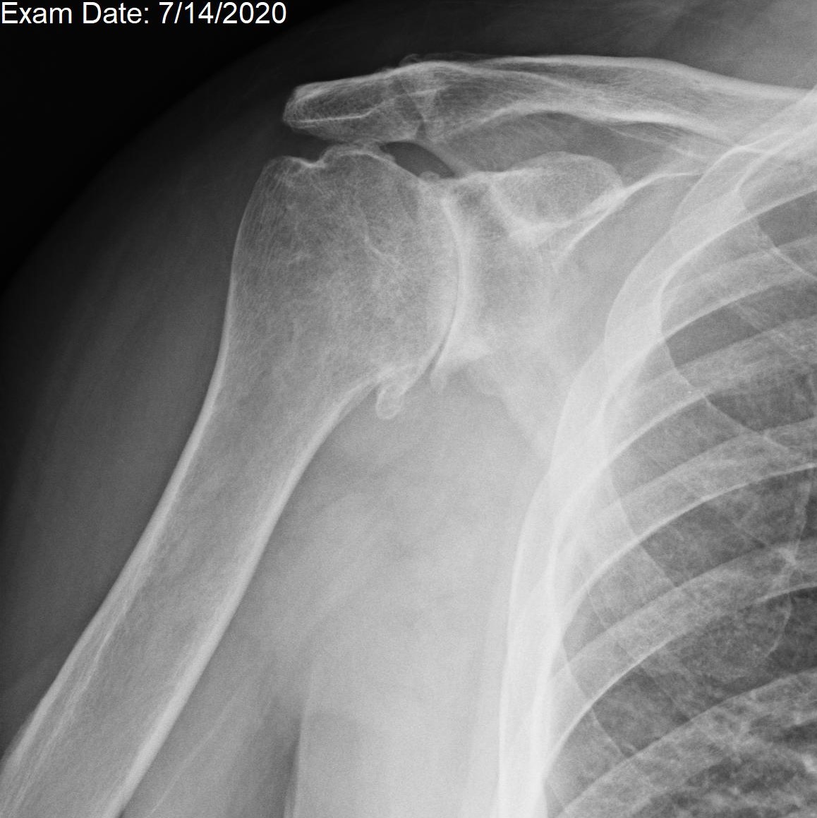 Flazzaraville's tweet photo. X-ray of painful stiff shoulder due to osteoarthritis. No MRI needed. Therapy will not help but would aggravate pain by grinding the bone surfaces together. Meds, modified activity or a total shoulder arthroplasty. #shoulderarthritis #totalshoulder #shoulderreplacement https://t.co/OlcKKnmXQ7