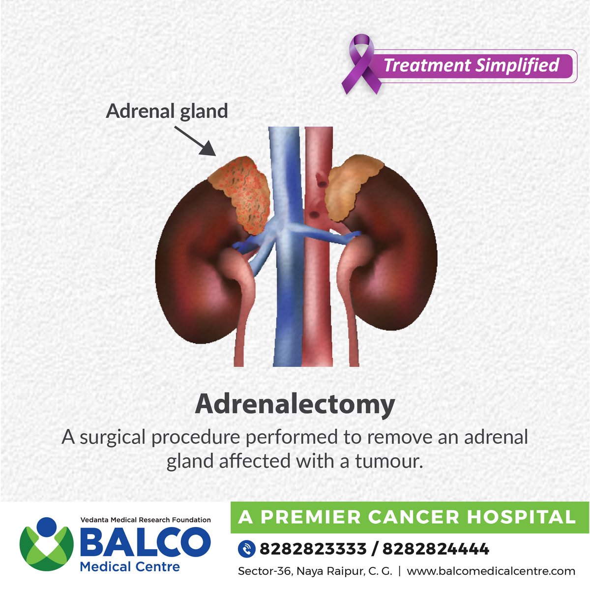 BalcoMedical's tweet photo. An #adrenalectomy is a surgical procedure performed to remove both benign and malignant tumors of the #adrenalglands. At #BMCRaipur, our team of expert surgical oncologists perform this procedure. #vmrf #TreatmentSimplified #cancercare #workingtowardscancerfreesociety https://t.co/mGv6JpSdtB