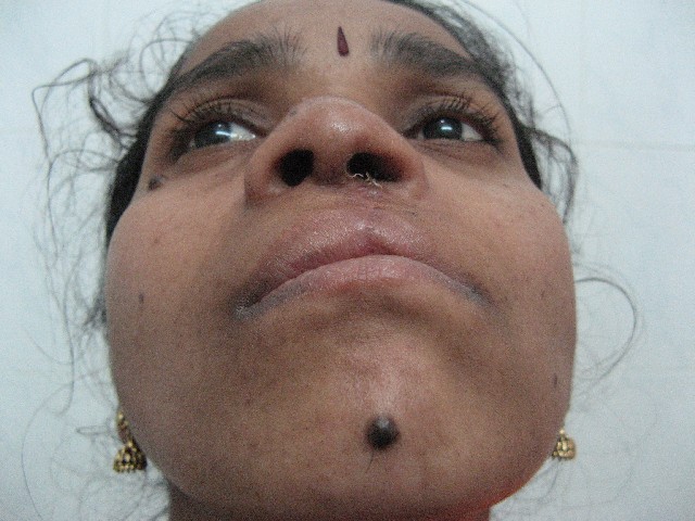 AndeiSoI's tweet photo. Cleft Rhinoplasty - one of the most challenging surgeries.

#cleftrhinoplasty #cleftrepair #nosejob #rhinoplasty #drsunilrichardson #maxfax #Medtwitter #MedEd https://t.co/yioDMWAvMO