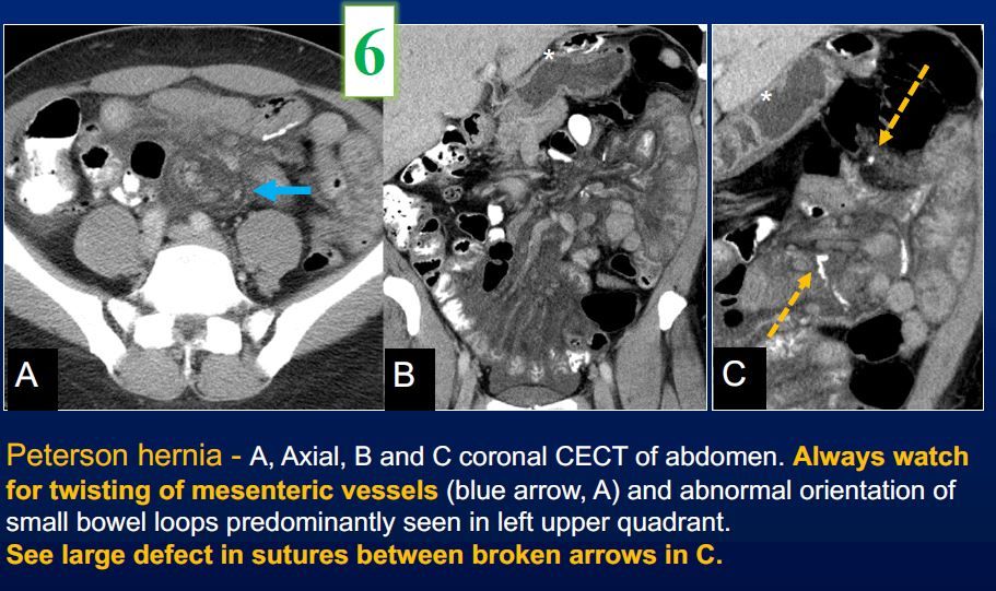 ERadSociety's tweet photo. Internal hernias occur in 2-10% of pts after gastric bypass. Challenging cases for #radiology! Peterson hernia occurs in potential space posterior to a gastrojejunostomy. Contrary to popular belief, this hernia was not named after legendary Twitter Educator @RyanBPetersonMD https://t.co/Z9ShVcmdgG