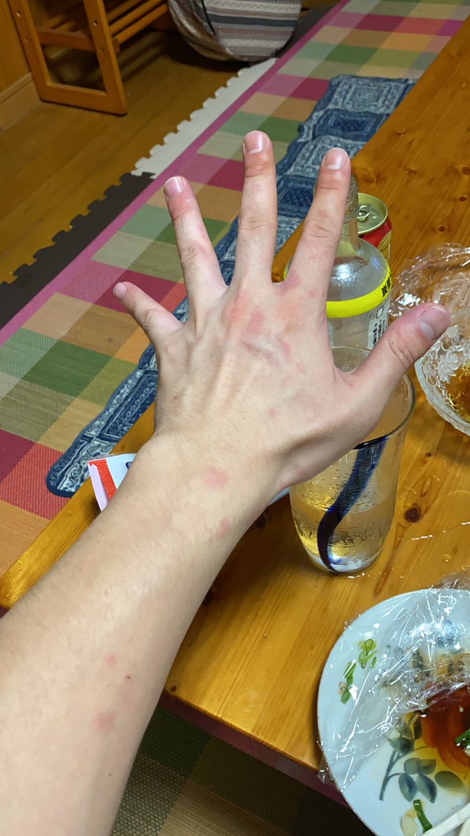 い く と A Twitter 最近酒飲むと腕とか足の一部に赤い斑点みたいなの出来るですよね 写真 みたいな感じです グロかったらごめん い く と A Twitter 最近酒飲むと腕とか足の一部に赤い斑点みたいなの出来るですよね 写真 みたいな感じです グロかったらごめん