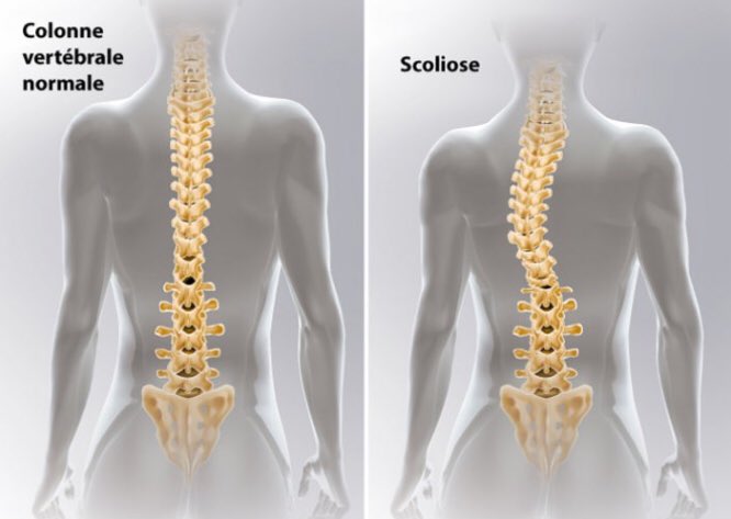 Petit rappel pour ceux qui ne savent pas avant de commencer : la scoliose est une déformation de la colonne vertébrale dans les 3 plans de l’espace (frontal, horizontal et sagittal). C’est une déviation non réductible contrairement à l’attitude scoliotique