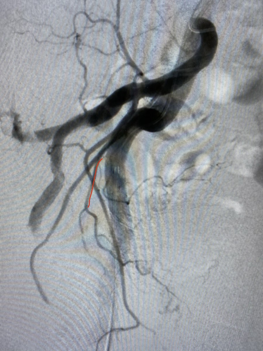 Excited to be doing PAEs again post COVID. Both patients happy and home as daycase.
Difference in anatomy on each side of pelvis still amazes me!
Case 1: L-Common origin with SV(type 2). Dyna CT-good coverage of hemiprostate. R off IPA(type 4) (high origin of IPA) 

#Irad #PAE