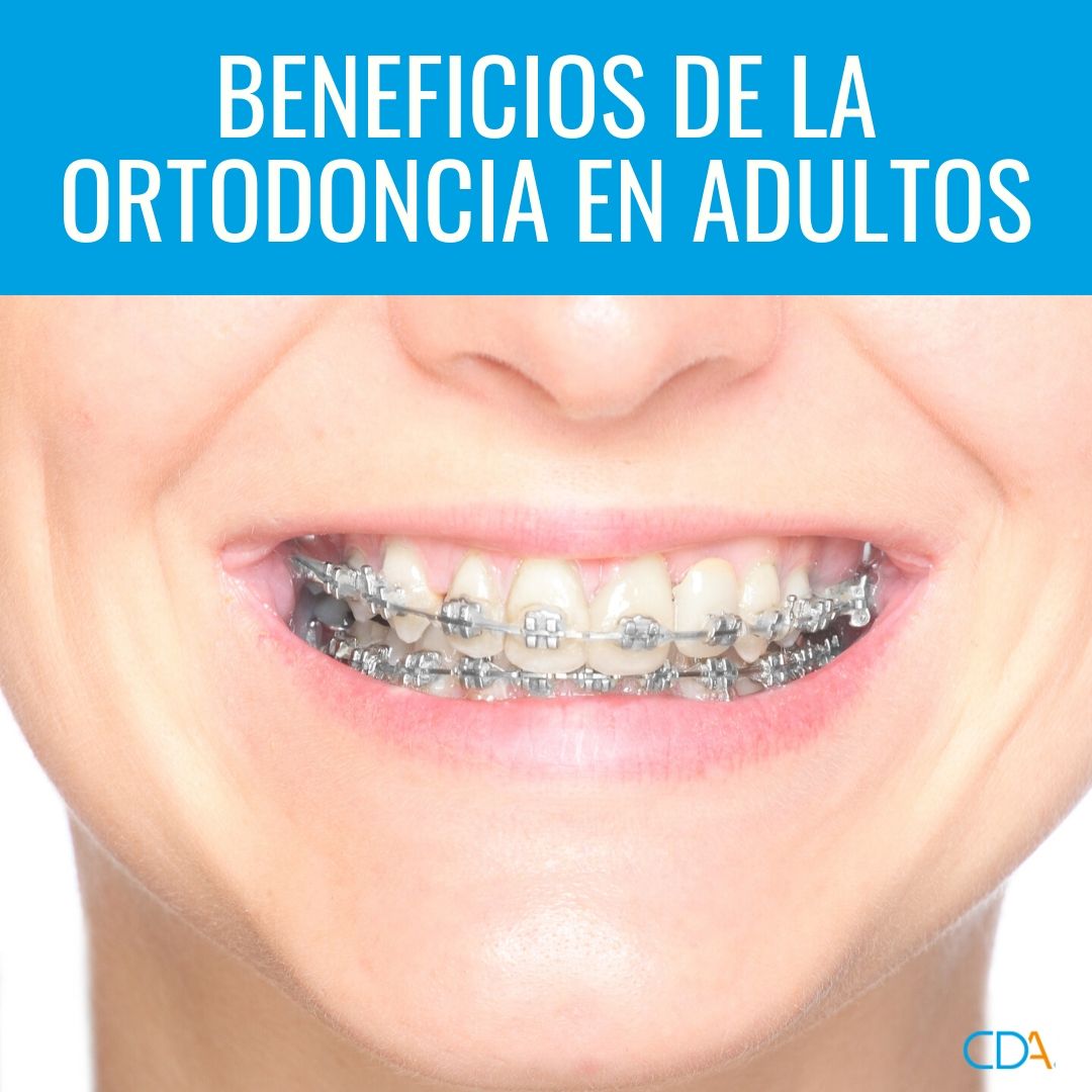 cdentala's tweet photo. 😀 La #ortodoncia hace tiempo que dejó de ser solo cosa de niños
Cada vez son más los adultos que la eligen, ¿por qué?
✔ Resultados sin dañar los dientes naturales
✔ Mejora tu #estéticadental sin necesidad de cirugía
✔ Método mínimamente invasivo
¡Consúltanos! 
#Leganés https://t.co/SlcIBrJAlU