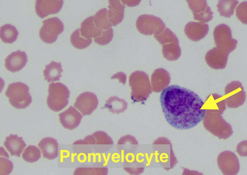 4/You checked for complications, stabilized the pt & sent flow cytometry. Now off to the lab!There you see: Many blasts (large nucleus, immature chromatin, scant cytoplasm) Few promyelocytes (light blue cytoplasm & magenta-staining granules)