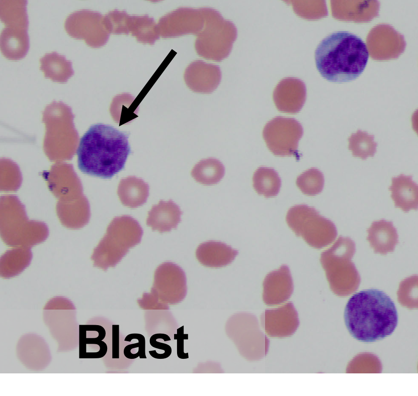 4/You checked for complications, stabilized the pt & sent flow cytometry. Now off to the lab!There you see: Many blasts (large nucleus, immature chromatin, scant cytoplasm) Few promyelocytes (light blue cytoplasm & magenta-staining granules)