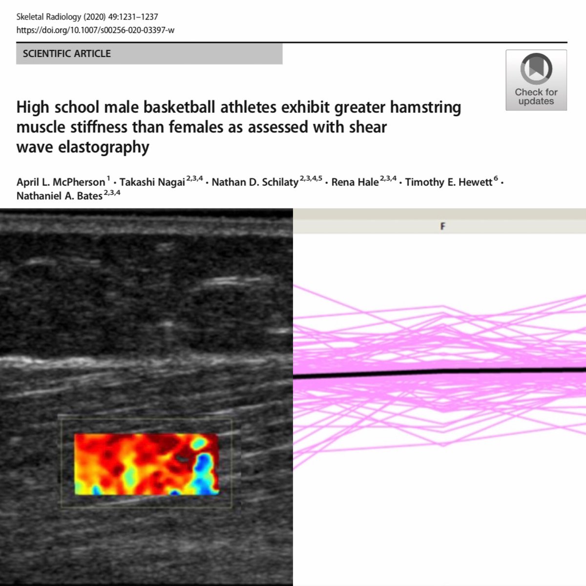 SkeletalRadiol's tweet photo. High school male basketball athletes exhibit greater hamstring muscle stiffness than females as assessed with shear wave elastography by McPherson et al. #MusculoskeletalUltrasound #SexDifferences #SkeletalMuscle #Biomechanics #ShearWaveElastography
https://t.co/VkKIKhD4k7 https://t.co/RWfs9pgxDC
