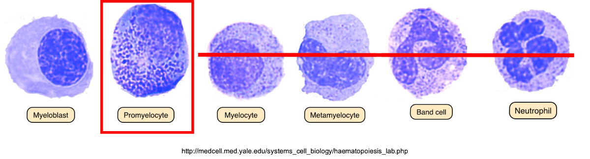 7/Dx: t(15,17) translocation (that results in fusion of PML-RAR gene). You don't need 20% blasts if that's presentPathophys: PML-RARA fusion protein blocks differentiation  cells are stuck in the promyelocyte stage