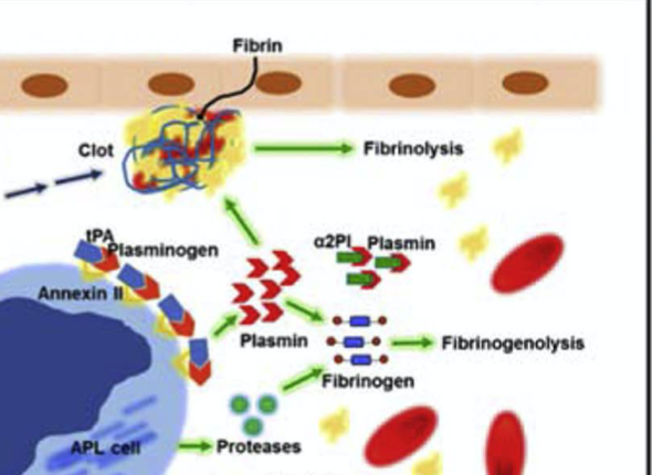 9/Simplified into 2 main mechanisms:DIC (unlike in sepsis there are higher levels of Protein C&S in APL hence  bleeding)HyperfibrinolysisAnnexin II (expressed on blasts)  plasmin by tPA dependent mechanism  fibrinolysis.More on this:  https://pubmed.ncbi.nlm.nih.gov/29703489/&nbsp;