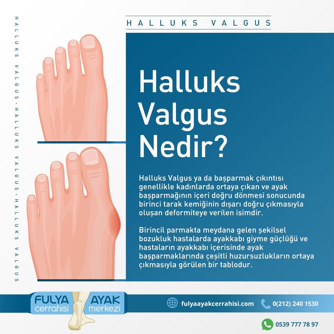 FulyaAyak's tweet photo. Halluks Valgus Nedir? 👉
Belirtileri Nelerdir? 👉
Kimlerde Daha Sık Görülür? 👉
Beraber Görülen Rahatsızlıklar Nelerdir? 👉
Tedavisi Nasıl Yapılır? 👉
Kimler Ameliyat Olmalıdır? 👉 https://t.co/kJAoImIorj