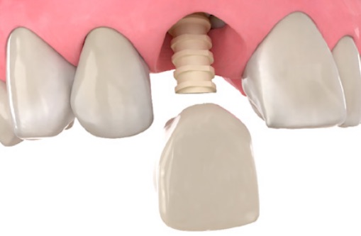 BioHorizons PEEK Temp cylinders are designed for use with a temporary cement or screw-retained provisional. Friction fit feature allows for snap-in retention of abutment during provisionalization, simplifying workflow. | biohorizons.com/Prosthetics/PE… #DentalImplants #HealthySmiles