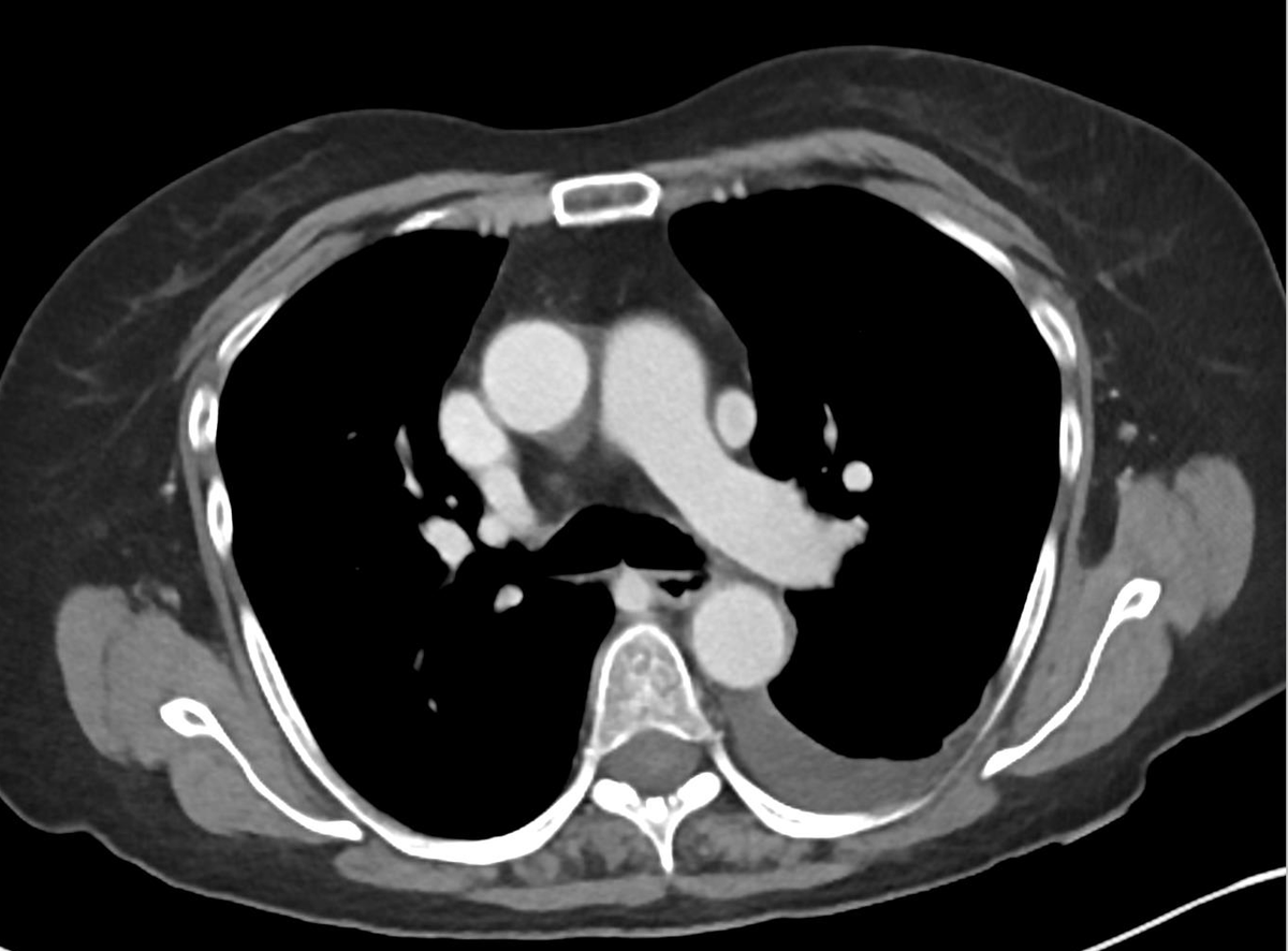 xsectional's tweet photo. The team repositioned the PICC and it went to the same exact location. Here is the follow-up CT, showing a persistent left SVC: 

#radres #CVrad #chestrad https://t.co/G5OKgffHrB