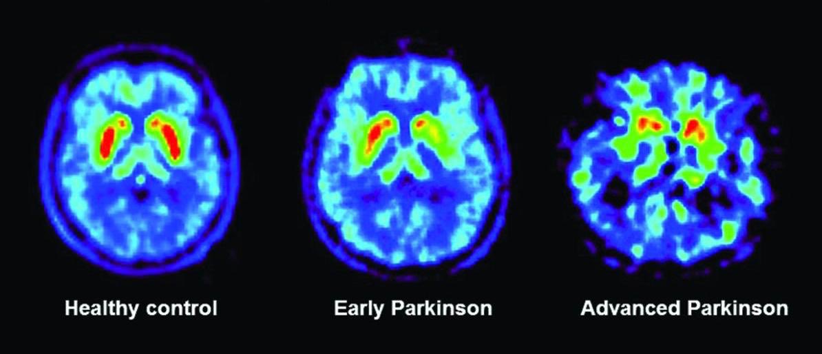 Hethq_'s tweet photo. باركنسون Parkinson
ثريد مهم يتكلم عن اضطراب باركنسون واسبابه وأعراضه ومراحله وعلاجه بالأدوية وجراحياً وعلاج طبيعي⬇️ https://t.co/AnrdSlo6ZL