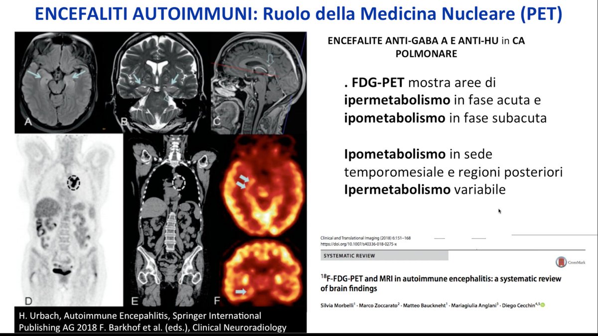#AINROnlineAcademy ruolo di FDG-PET in encefaliti autoimmuni: paper suggerito link.springer.com/article/10.100… #neurorad #radres #pet #NuclearMedicine