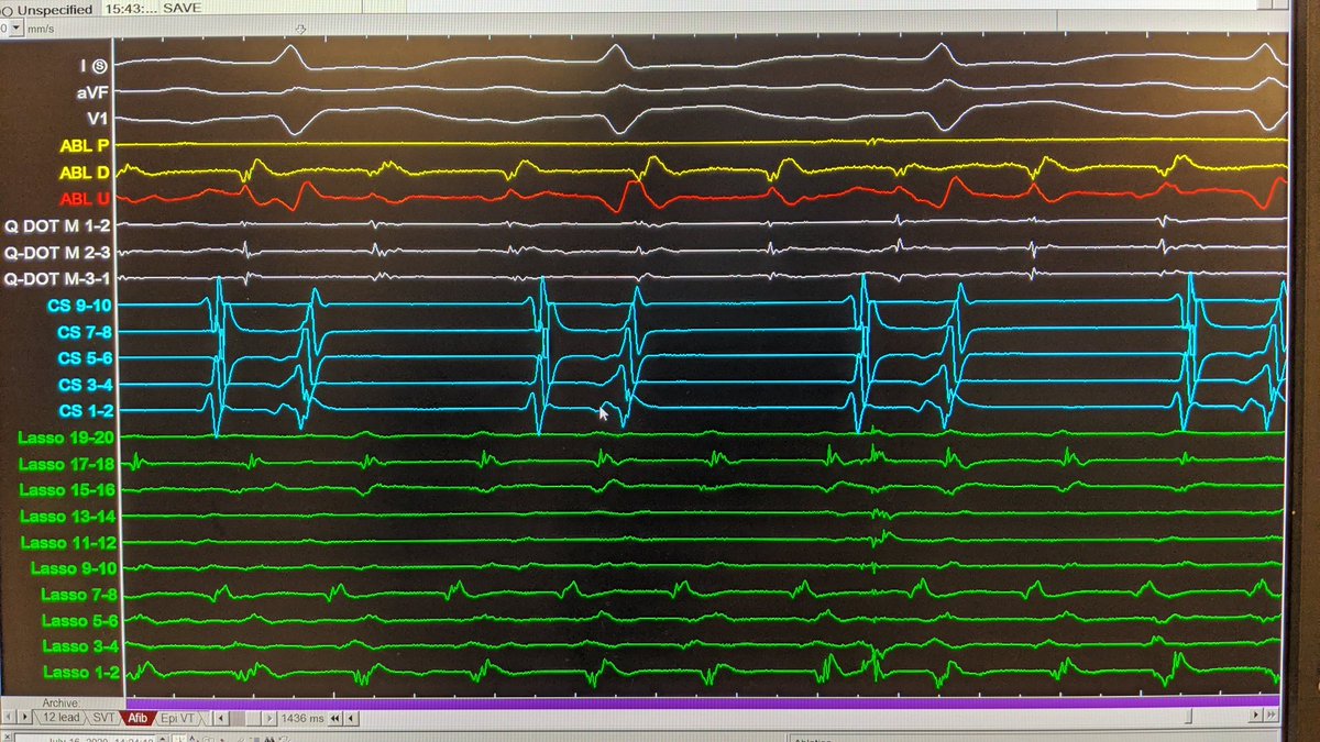 #EPeeps it is rewarding to see dissociated potentials after PVI... 

But all 4 veins fibrillating while patient in NSR... Makes my day!!