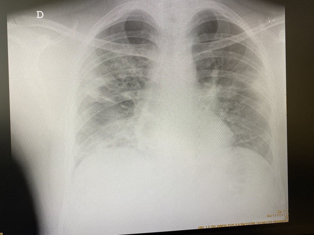 Varón 33 años. Sin comorbilidad (no enfermedades previas). Ingresa ayer por neumonía bilateral por #SARSCoV2 #Covid. Hoy ha habido que trasladarlo a la UCI.

#EstáPasando Sean responsables. Por ustedes. Por ellos. Por nosotros. Por todos