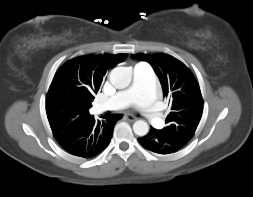 Aneurysmal Dilatation of the Main Pulmonary Artery: ctisus.com/responsive/tea…