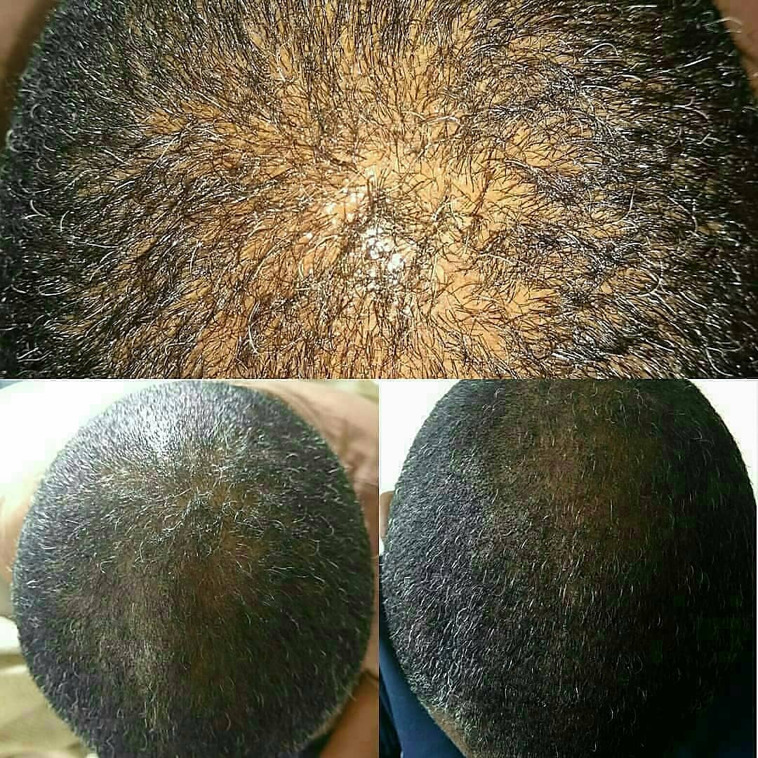 EdensLegends's tweet photo. Significant growth in area where it was receding in just 10 days.
Growth and thickness restoring after using Afro-Nutritious.
#handmade #organic #hairbutter
#hairgrowth #recedinghair #vegan #plantbased
https://t.co/2c8FveyrLF https://t.co/K6cqbjYotd