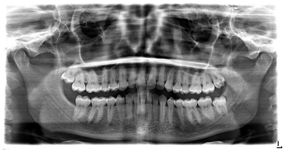 I also have some wonderful x-rays of myself, look at my cute skull ??
