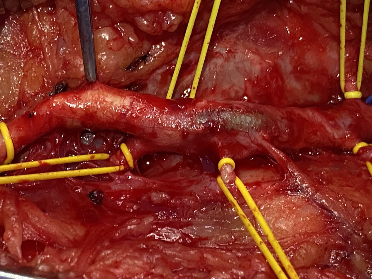 Scott S. Berman, MD, MHA, RVT, FACS, DFSVS tweet media