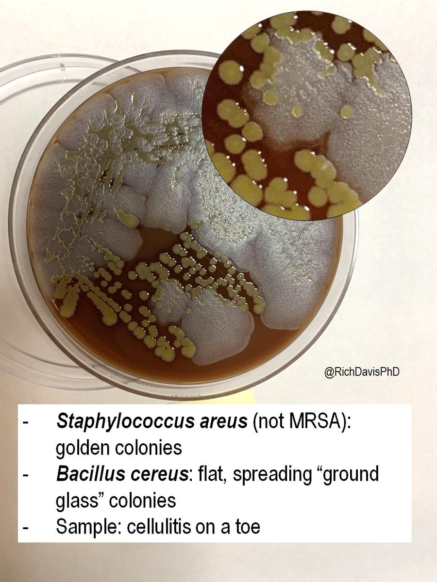 richdavisphd's tweet photo. #MicroRounds (Day 693): "toe was nailedโฆ"
Patient with painful cellulitis of the toe. Culture grew two classic-presenting morphologies of Staphylococcus aureus (Latin for golden) and Bacillus cereus (spreading "ground glass")
#ASMClinMicro #IDTwitter https://t.co/dd8vXPtZ0x