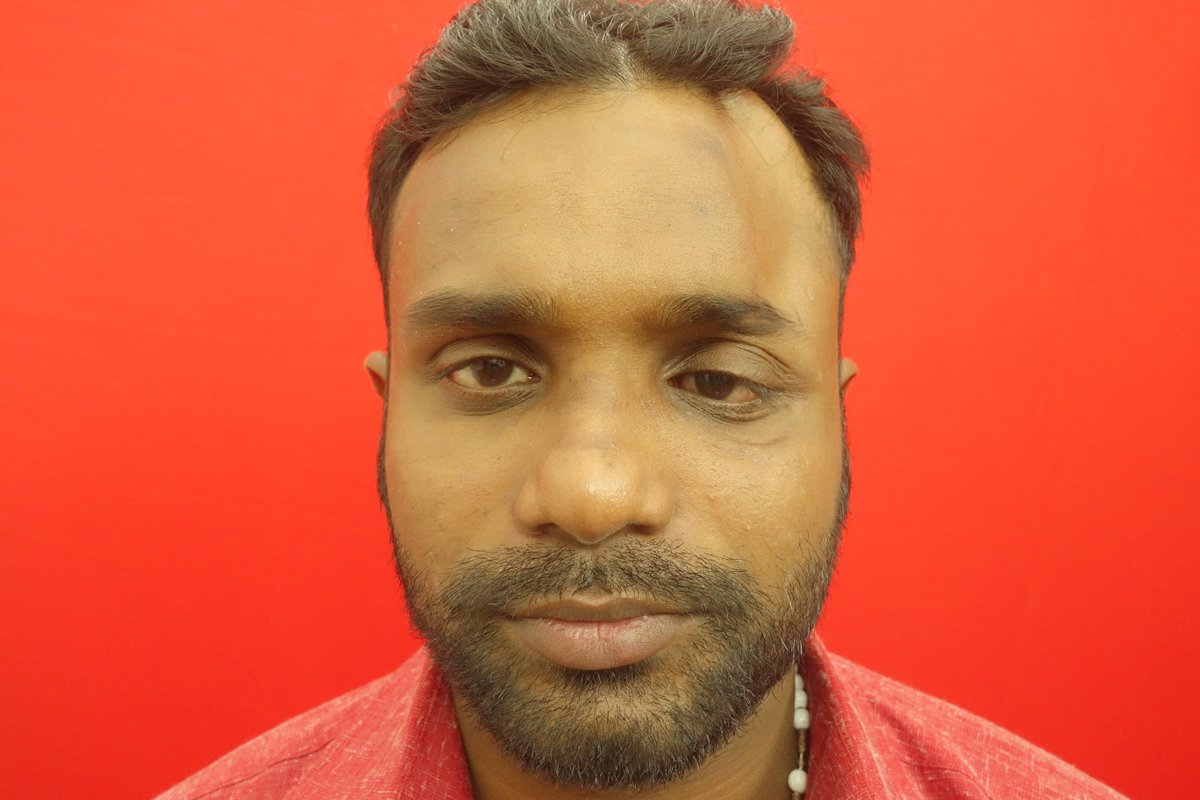 AndeiSoI's tweet photo. A deformity on the forehead
#facesurgeon #facedoctor #maxfax #drsunilrichardson #facedeformity #MEdtwitter #MedEd https://t.co/PmkW5e3fyt