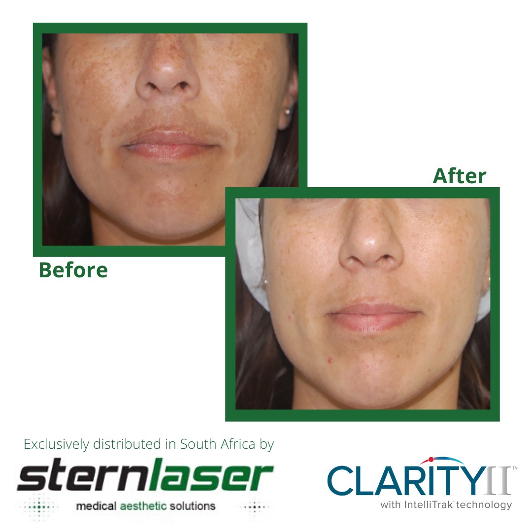 SternlaserSA's tweet photo. Clarity ii does not only remove unwanted hair, but is also used to brilliantly remove pigment and vascular lesions.

#Sternlaser #aestheticpartner #Lutronic #LaserHairRemoval #HairRemoval https://t.co/11H0VBybPI