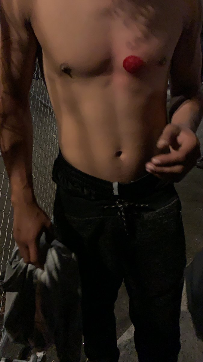 OK police have retreated. I don’t know what happened but a Black protester has been shot in the chest with some kind of less-lethal munition. He says he feels like his rib is broken. He also says an officer shot it out of a car. That’s all the info I have but here’s a photo.