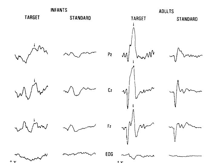 We can often see similar patterns in the brain waves across people of different ages. However, there are typically differences in the brain waves of infants and adults when we 'process' the data and look at it in smaller chunks. Brain waves are typically more definitive in adult