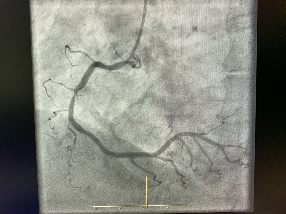 Hemodin_LaPaz's tweet photo. Another patient in @theFIRE_trial and first case in Madrid (2nd in Spain) with #COMET_II Nice improvement of the device. @BSCCardiology @shci_sec @RaulmorenoMD @hemodin90 @ari_gonzalvez @AJuradoRoman @SMorala @drbijagua https://t.co/NtBd7nVEbm