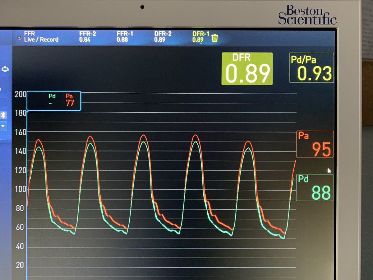 Hemodin_LaPaz's tweet photo. Another patient in @theFIRE_trial and first case in Madrid (2nd in Spain) with #COMET_II Nice improvement of the device. @BSCCardiology @shci_sec @RaulmorenoMD @hemodin90 @ari_gonzalvez @AJuradoRoman @SMorala @drbijagua https://t.co/NtBd7nVEbm