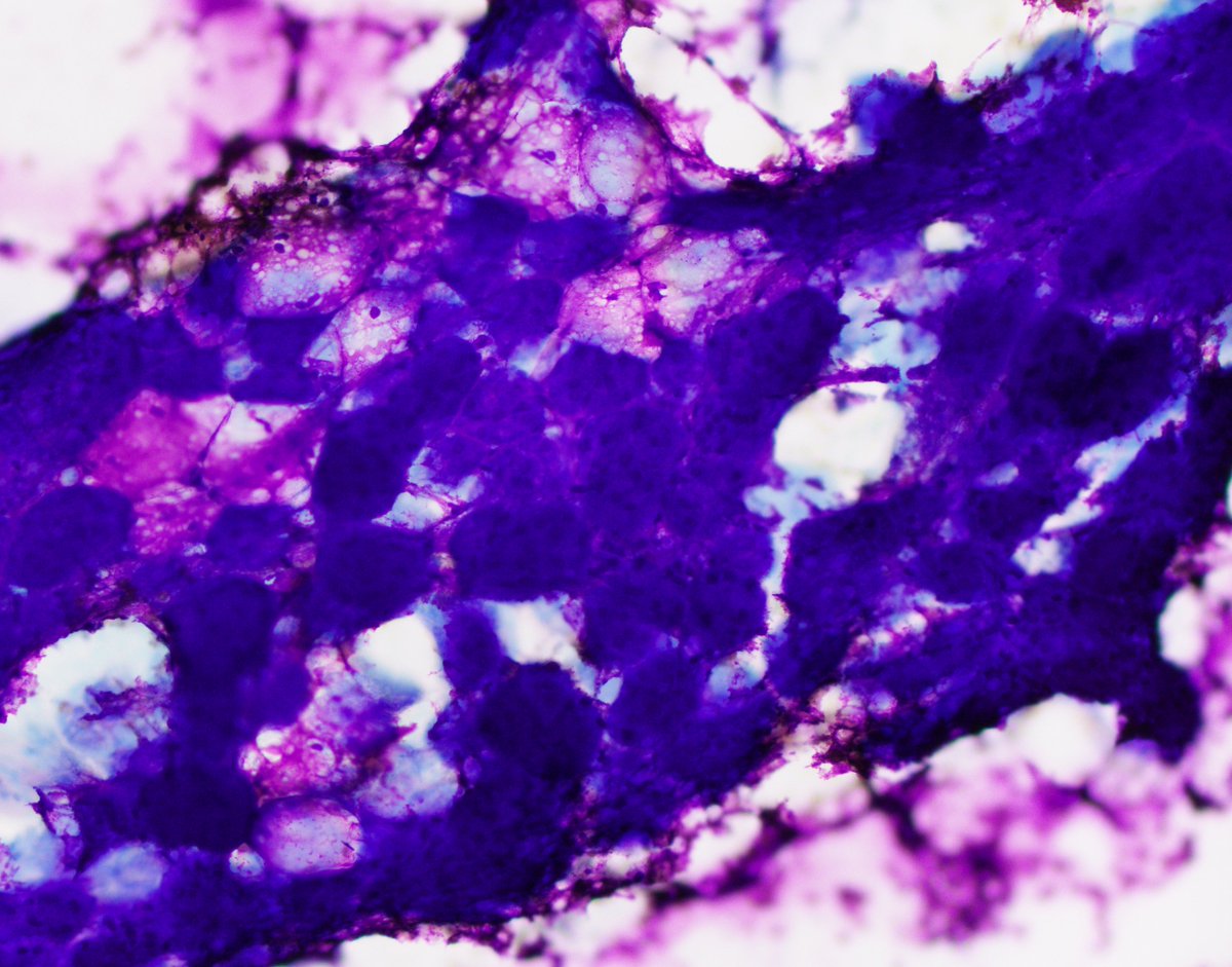 HubertLauMD's tweet image. Submandibular mass FNA. What is the pattern, and what is your differential diagnosis? #FNAfriday #FNApath #Cytopath #ENTpath