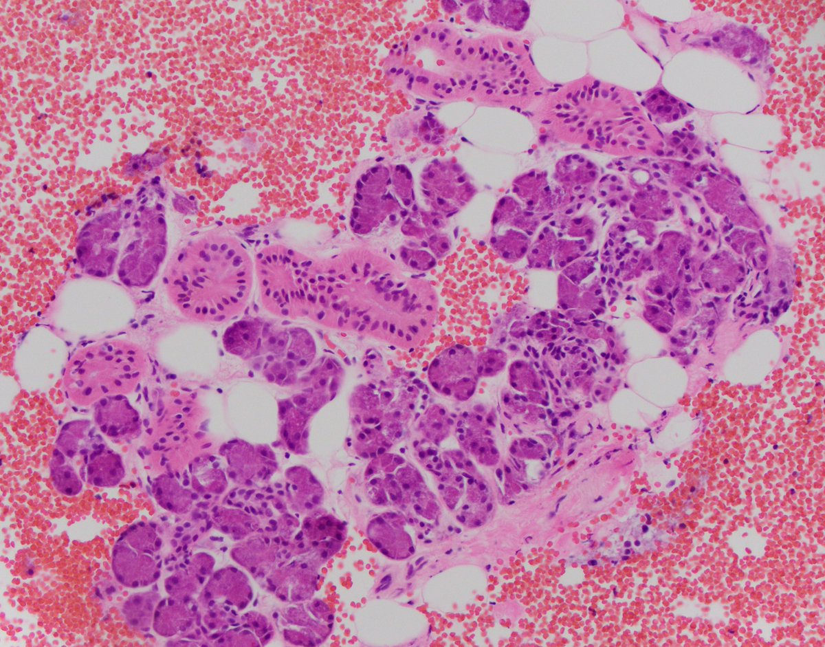 HubertLauMD's tweet image. Submandibular mass FNA. What is the pattern, and what is your differential diagnosis? #FNAfriday #FNApath #Cytopath #ENTpath