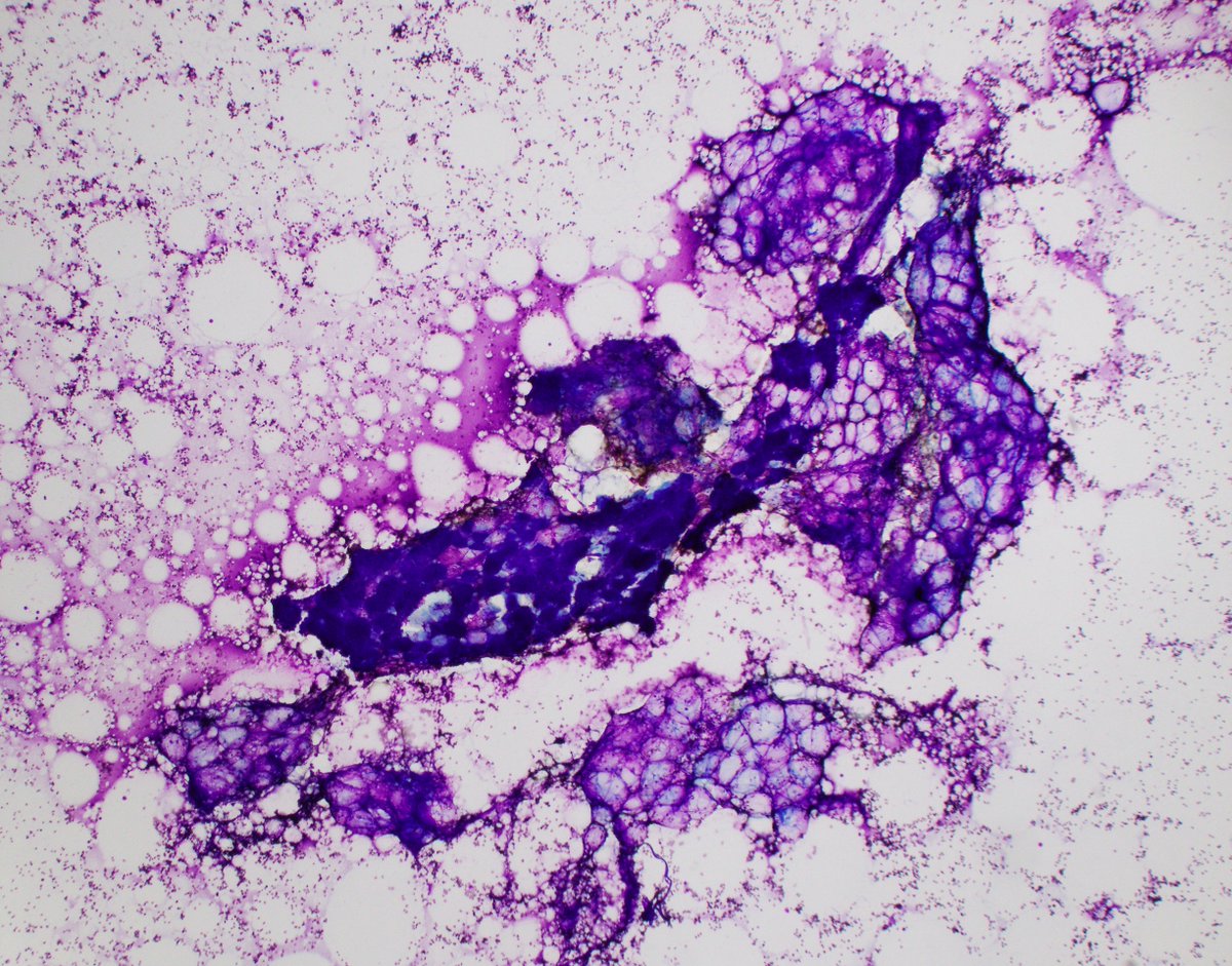 HubertLauMD's tweet image. Submandibular mass FNA. What is the pattern, and what is your differential diagnosis? #FNAfriday #FNApath #Cytopath #ENTpath