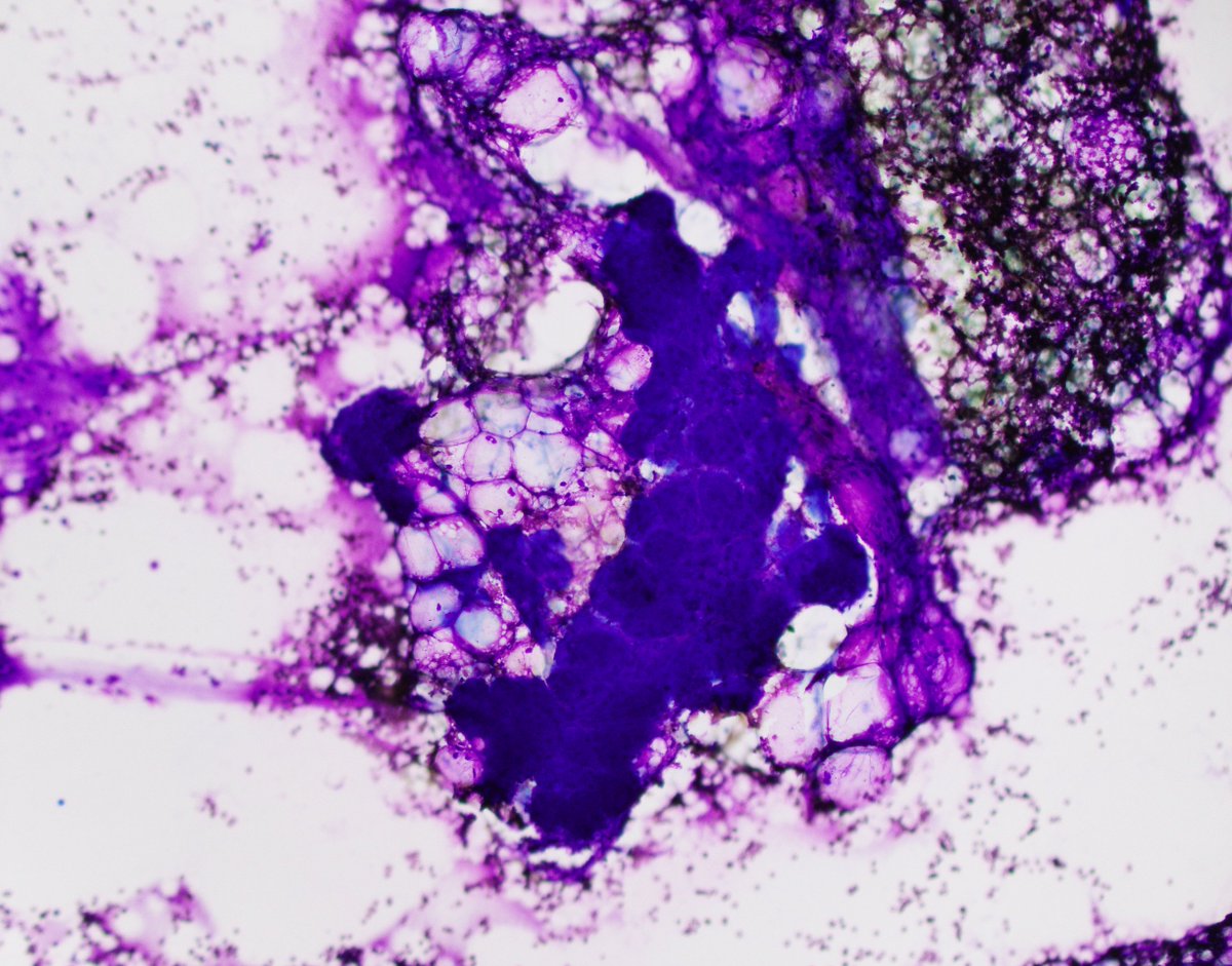 HubertLauMD's tweet image. Submandibular mass FNA. What is the pattern, and what is your differential diagnosis? #FNAfriday #FNApath #Cytopath #ENTpath