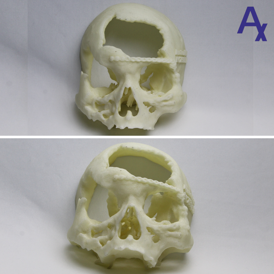 Anatomiz3D's tweet photo. In the case of the frontal bone of the cranium along with orbital roof, this 3D printed model helped the medical team in understanding the situation with respect to the existing implants and plan for the revision surgery for reconstruction.

#Healthcare #3DPrinting #Anatomy https://t.co/lRKmeZmTd2