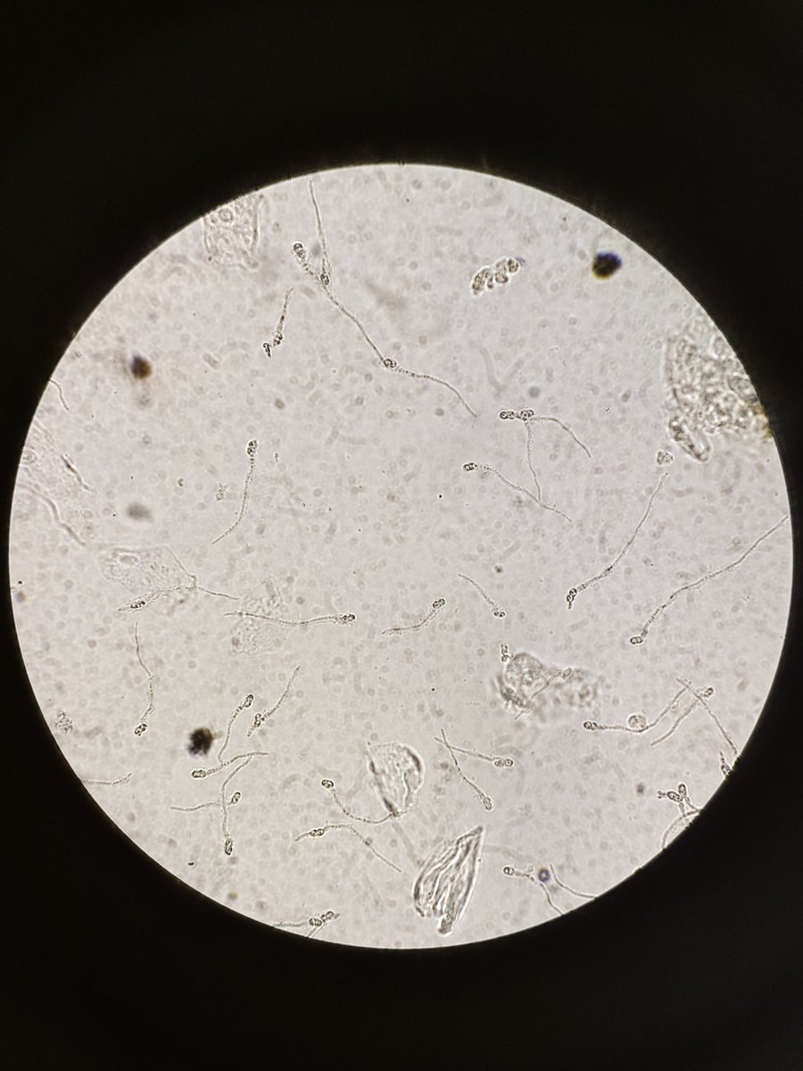 marjorieannepc's tweet photo. Makapamalikas nalang gyud ka kung makakita ka ani under the microscope gikan sa ihi sa bata nga 10 years old. 

Female? YES‼️ 😩💔

Spermatozoa seen. https://t.co/hiUOHUevO3
