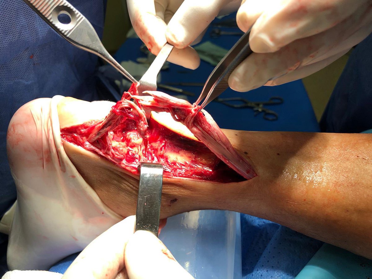 machofisio's tweet photo. Importancia de conocer el trabajo multidisciplinar en la fase postoperatoria de #fisioterapia. Reparación rotura completa tendon Aquiles. Vemos relación entre el el tendón y la grasa de kager con imagen de eco donde se aprecian ramas geniculadas que se pueden ver afectadas. https://t.co/RepeLTZ0W0