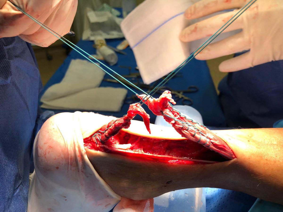 machofisio's tweet photo. Importancia de conocer el trabajo multidisciplinar en la fase postoperatoria de #fisioterapia. Reparación rotura completa tendon Aquiles. Vemos relación entre el el tendón y la grasa de kager con imagen de eco donde se aprecian ramas geniculadas que se pueden ver afectadas. https://t.co/RepeLTZ0W0