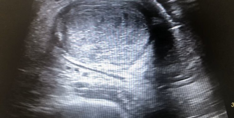 machofisio's tweet photo. Importancia de conocer el trabajo multidisciplinar en la fase postoperatoria de #fisioterapia. Reparación rotura completa tendon Aquiles. Vemos relación entre el el tendón y la grasa de kager con imagen de eco donde se aprecian ramas geniculadas que se pueden ver afectadas. https://t.co/RepeLTZ0W0