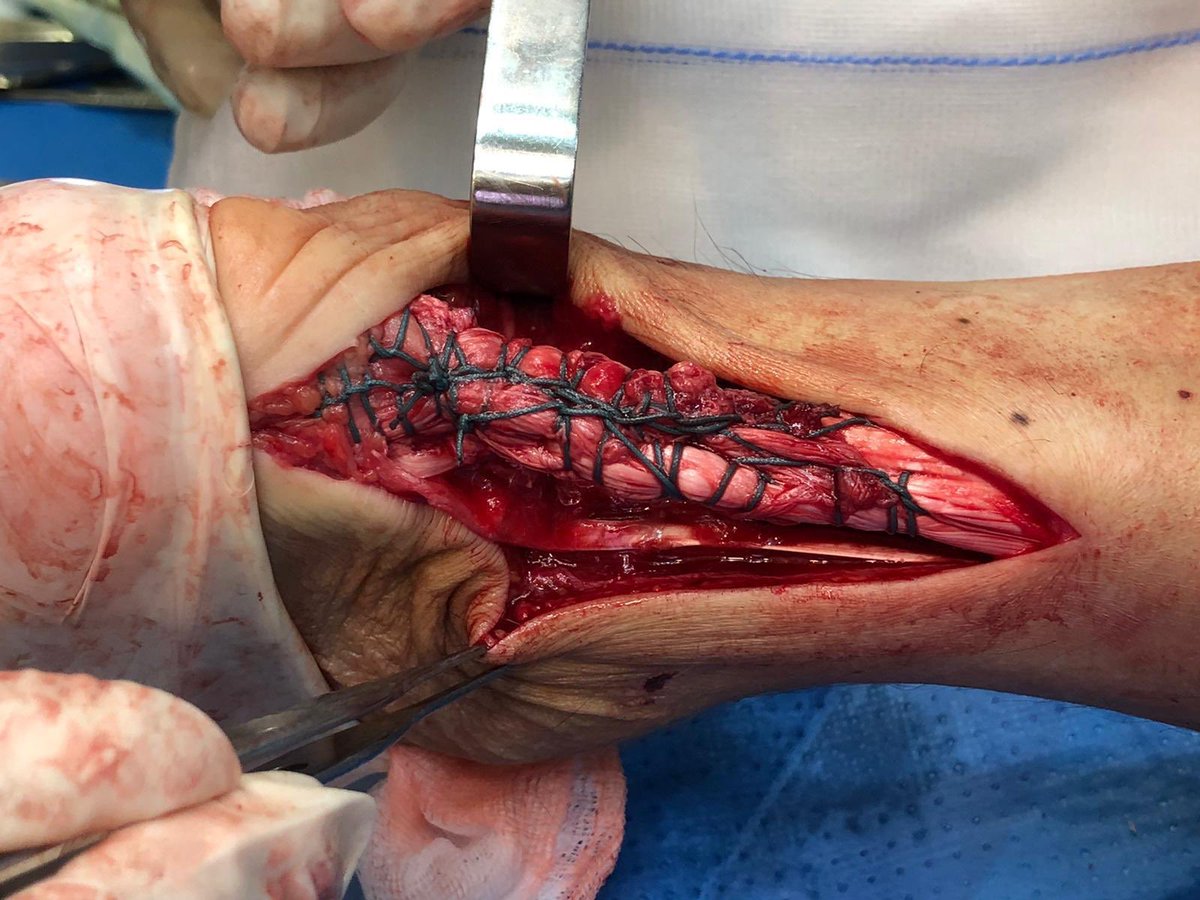 machofisio's tweet photo. Importancia de conocer el trabajo multidisciplinar en la fase postoperatoria de #fisioterapia. Reparación rotura completa tendon Aquiles. Vemos relación entre el el tendón y la grasa de kager con imagen de eco donde se aprecian ramas geniculadas que se pueden ver afectadas. https://t.co/RepeLTZ0W0