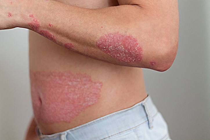 vitaly_prl's tweet photo. ¿Sabías que con los nuevos fármacos para la terapia de la #psoriasis se puede conseguir una efectividad estimada por encima del 80%? Descubre las nuevas terapias desarrolladas para tratar esta enfermedad en el #Blogsaludos de #CualtisSalud
https://t.co/xlVm8RRPna https://t.co/xpGyKyZajR