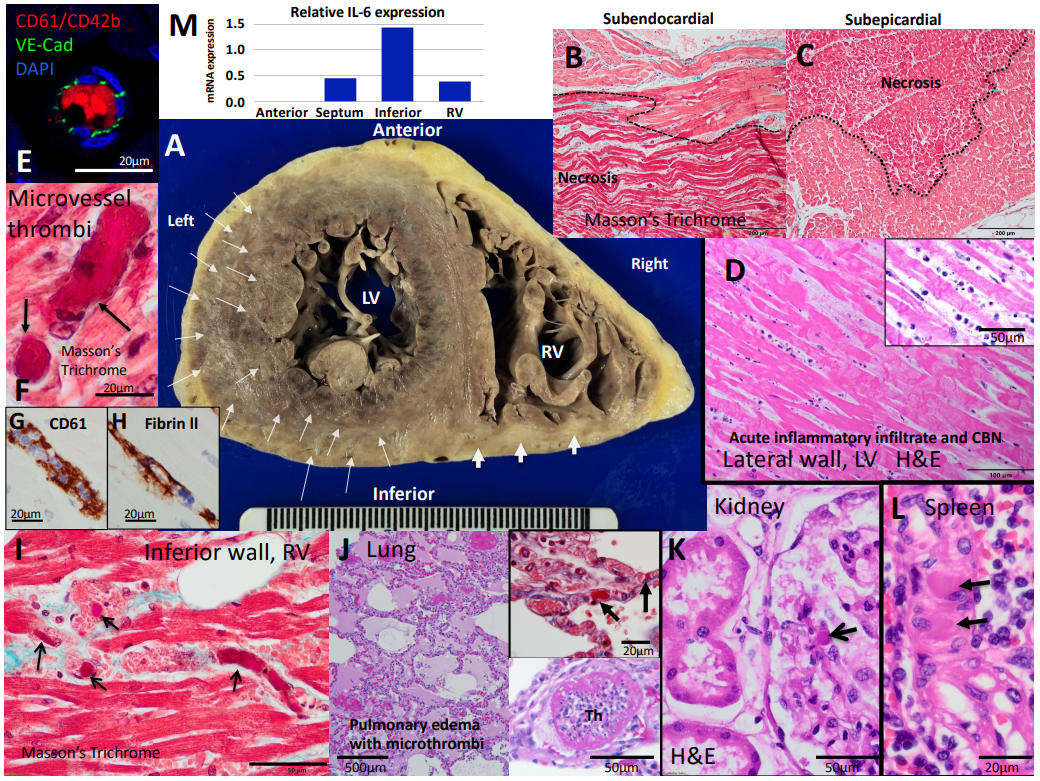 CircAHA's tweet photo. Just Published Online: #CaseSeries: Microthrombi and ST-Segment Elevation Myocardial Infarction in #COVID19. Learn more: https://t.co/iKN2mO9Jji #AHAJournals #AHACOVID19 @AHAScience https://t.co/su0snlILdA