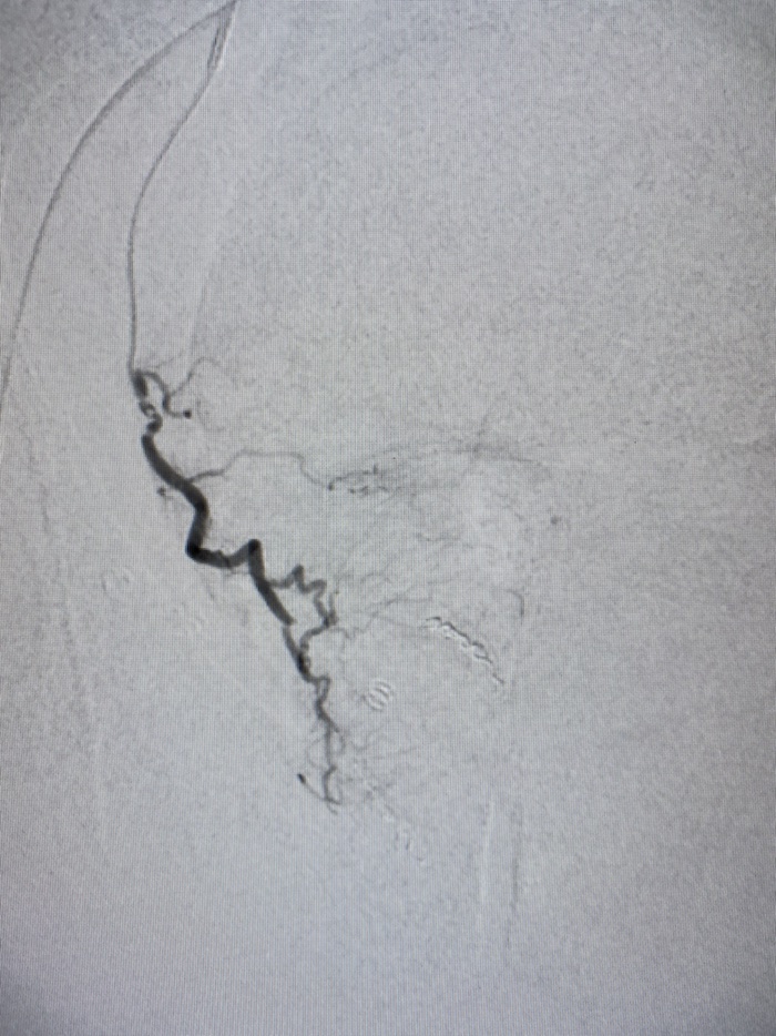 Case 2: Nice PA off obturator(type 3). Anastomses to IPA and bladder coiled prior to embolisation. #PAE
