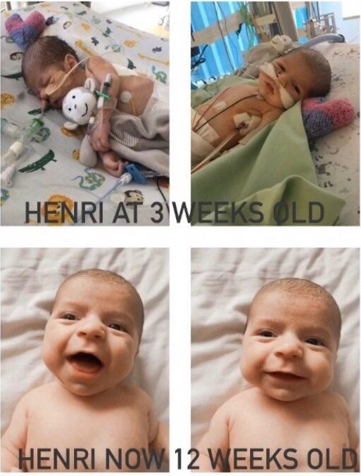 Henri is 12 weeks old 👶 and was born with a congenital heart defect 💔 He first came to Alder Hey 🏥 when he was 3 weeks old, after being admitted to his local hospital a week earlier for unusual breathing, where they found a heart murmur and two congenital heart defects 😢