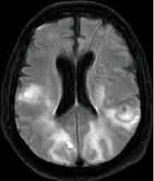 Hernández-Fernández et al. report an incidence of cerebrovascular disease of 1.4% in patients hospitalized with #COVID-19 in an area of Spain with high levels of SARS-CoV-2 transmission. <a href="/Oscarayomartin/">Oscar Ayo-Martin</a>
 @GeorgesCayo <a href="/tseguram/">TOMAS SEGURA</a>
 bit.ly/2W4iymO