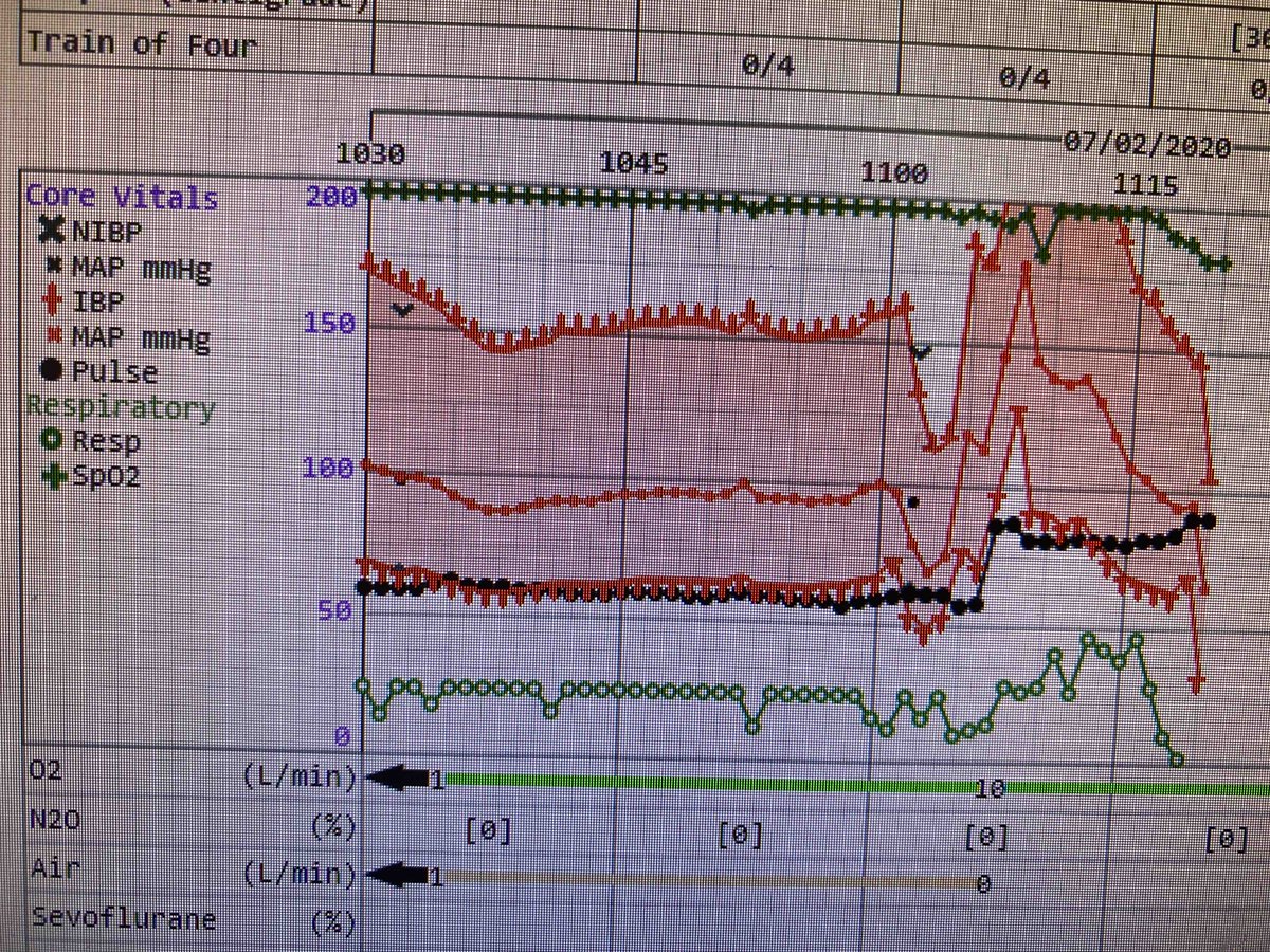 aartisarwal's tweet photo. How does #Autoregulation factor in transient fluctuations of BP? Did this cause the patients watershed #stroke? How do you decide in #neuroicu when and who to assess autoregulation in? 👩🏻💻👩🏽⚕️🤷🏻♀️
#NeuroCritCare enigmas!
@neurocritical @SCCM @StrokeAHA_ASA https://t.co/fiImqtTn5k