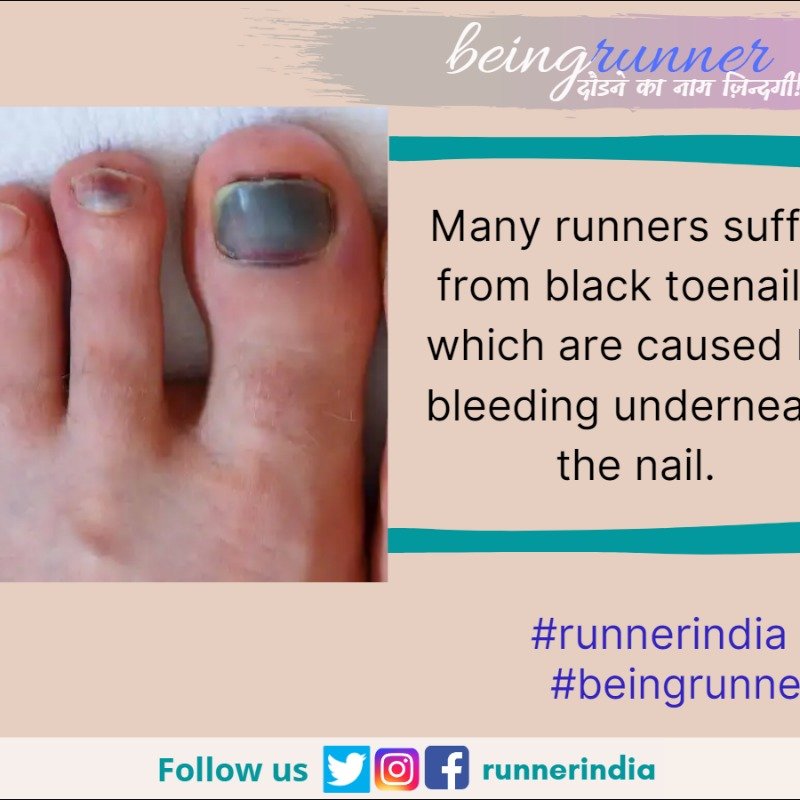 runnerindia's tweet photo. How do you treat this??

#black #toenail #runners #running #injury #motivation #hardwork #beingrunner #runnerindia #follow #like https://t.co/w9cNeF6kkm