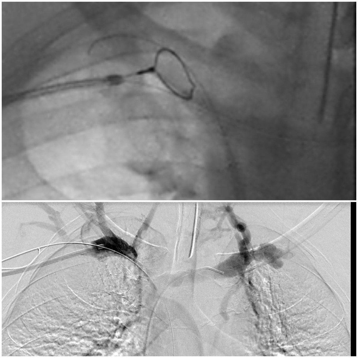 AshourMD's tweet photo. #SVC syndrome, failed recan in outside facility.
Rt. AVF, occlusions innomonate veins confluence, upper SVC and lt subclavian-axillary vein.
#Sharp_recanalization
@KFSHRC_J @sirs_ksa @VeinForum @BSIR_News @SIRRFS @CVIR_Journal @MoonJustaniah @marabi2004 https://t.co/r4zhCd59Ow